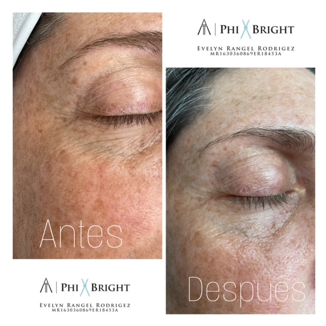 An under-eye before and after microneedling 