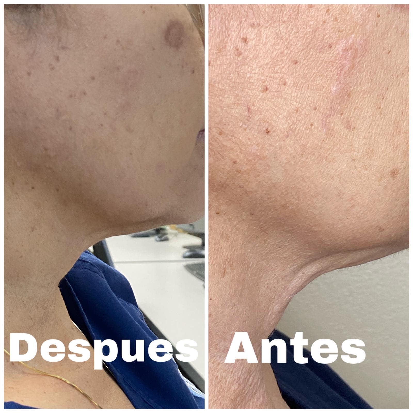 a neck before and after fibroblast 