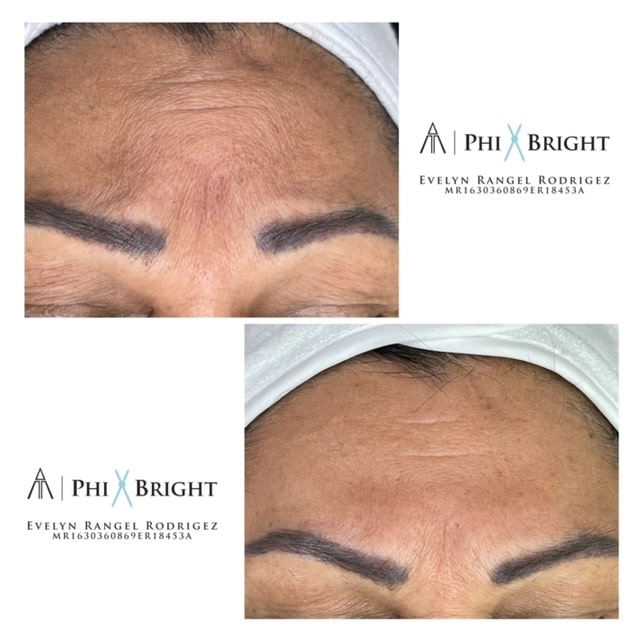 A forehead before and after microneedling 