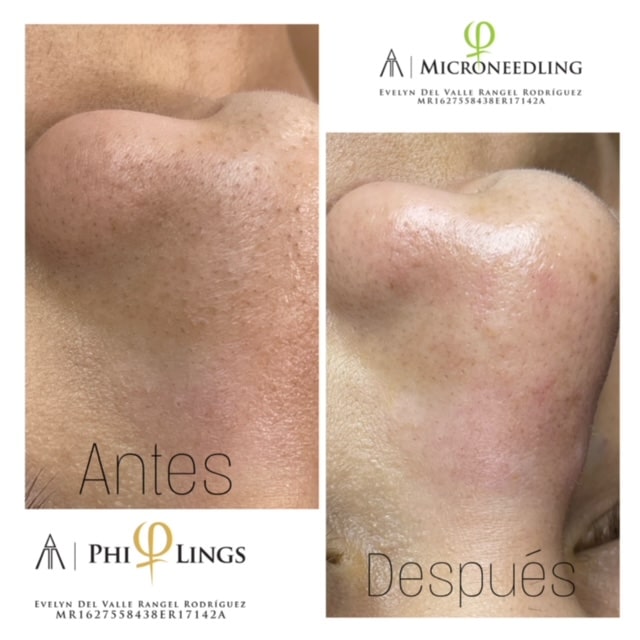 A nose before and after microneedling 