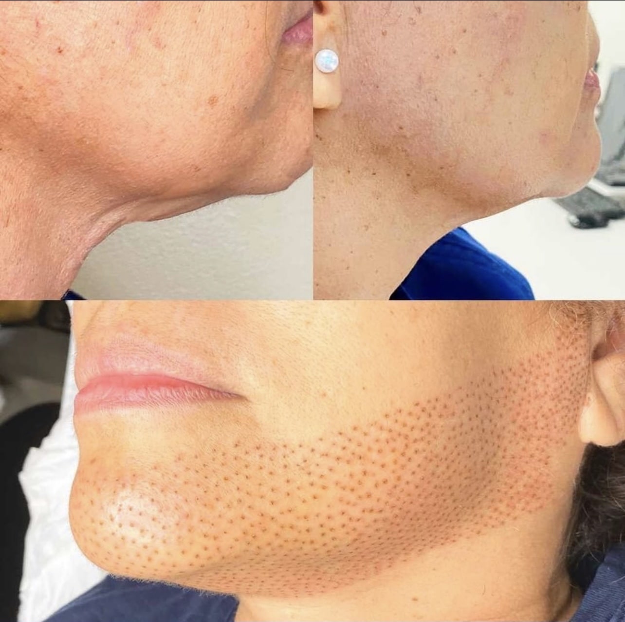a chin before and after fibroblast 